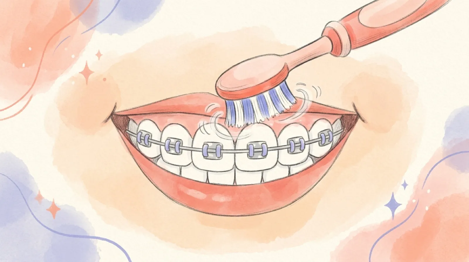 Gezeichnet: Zahnbürste schräg von oben am Zahnfleischrand über den Brackets